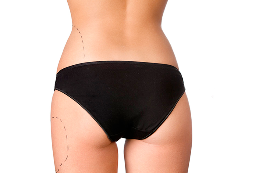Mesoterapia e intralipoterapia