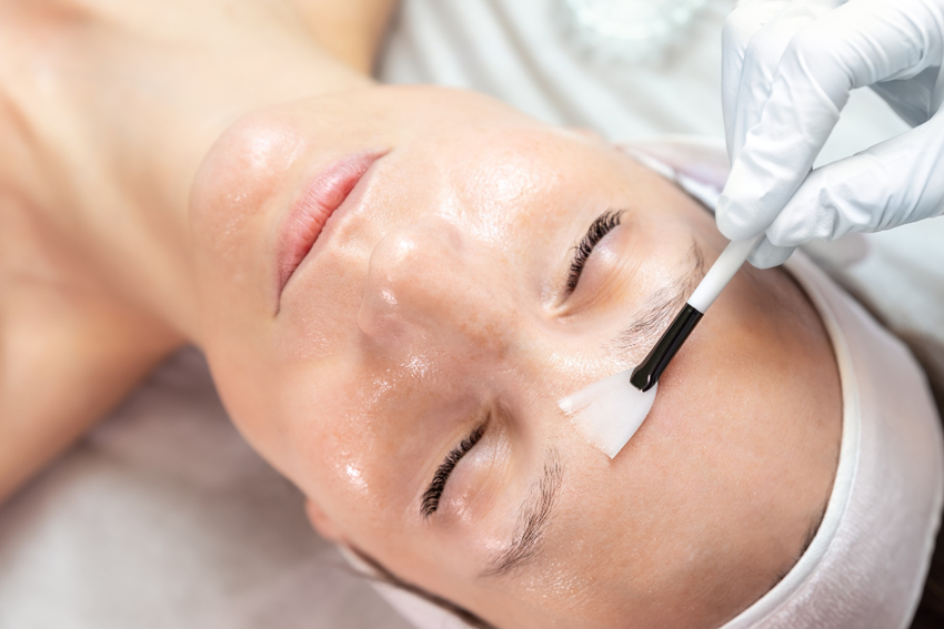 Peeling químico